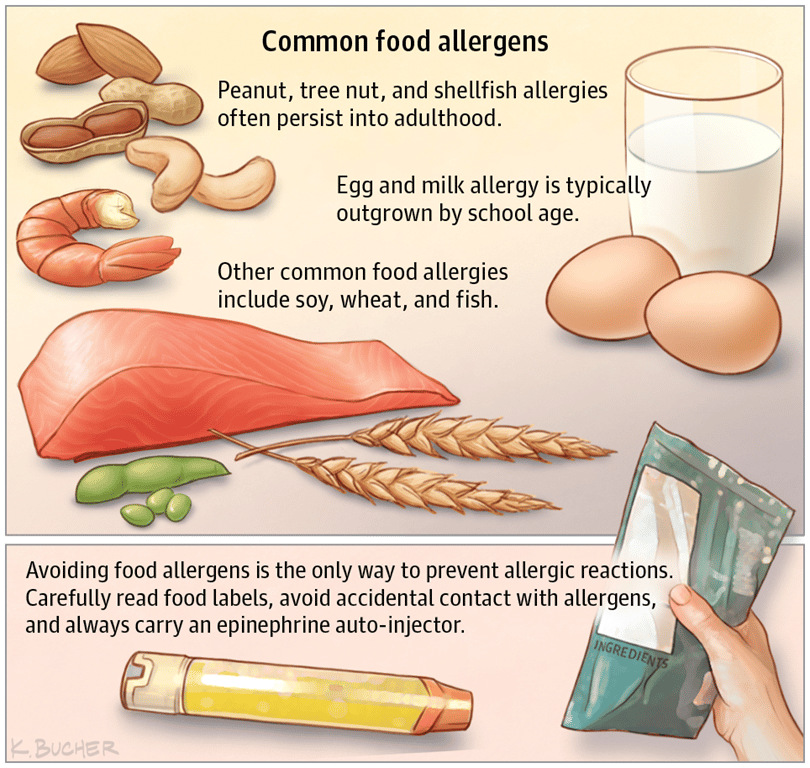 Treatments for Food Allergies