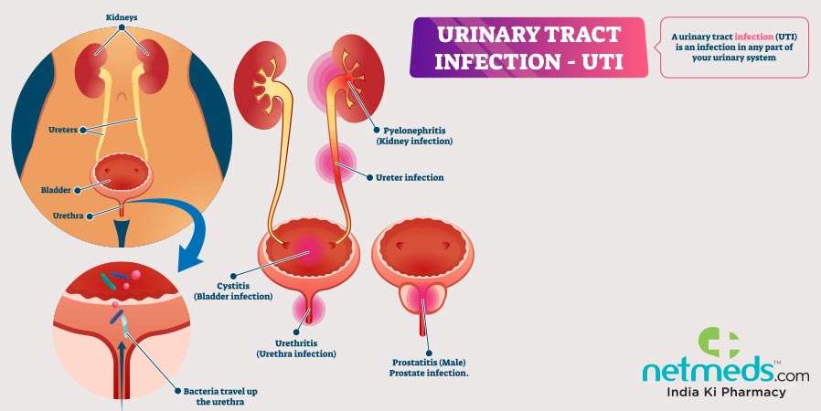 Urinary Tract Infection (UTI): Causes, Symptoms And Treatment
