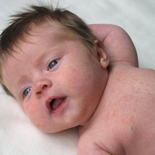 What causes allergies in babies?
