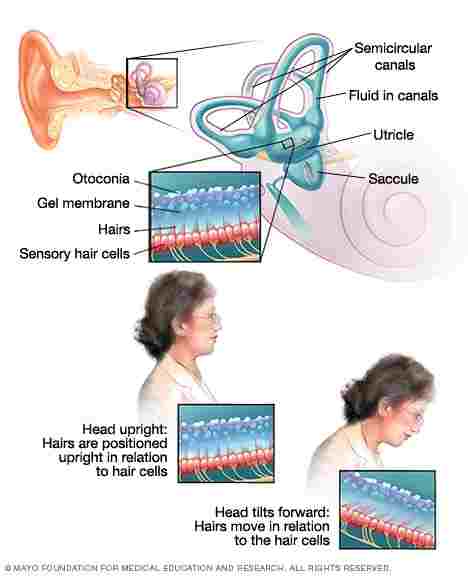 What Causes Headaches And Dizziness And Nausea Fluid Ear ...