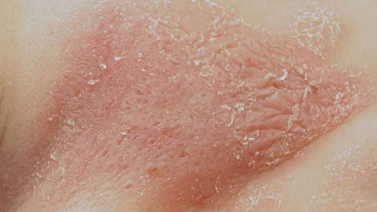 What causes pad rash, treatment, and what does it look like?