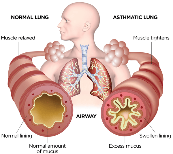 What Happens in Your Airways When You Have Asthma?