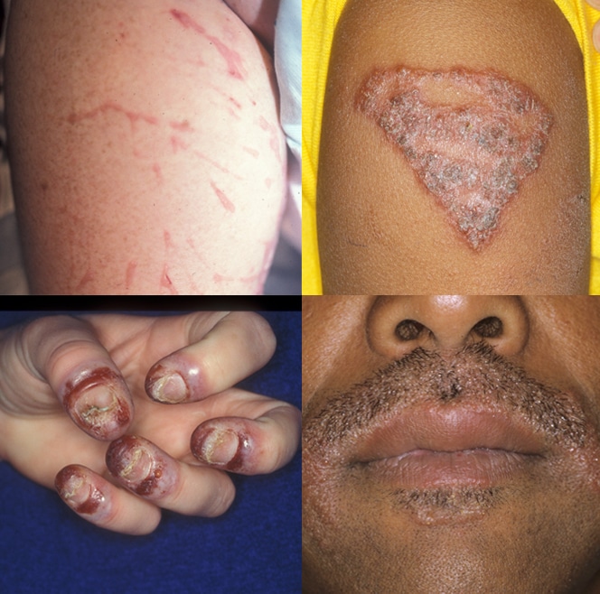 What is an allergic skin reaction?