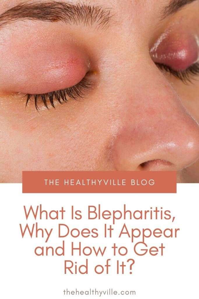 What Is Blepharitis, Why Does It Appear and How to Get Rid ...