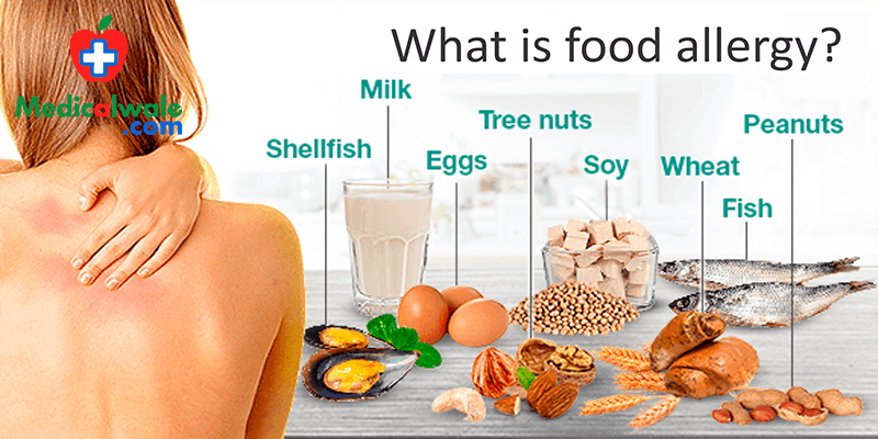 What is Food Allergy?