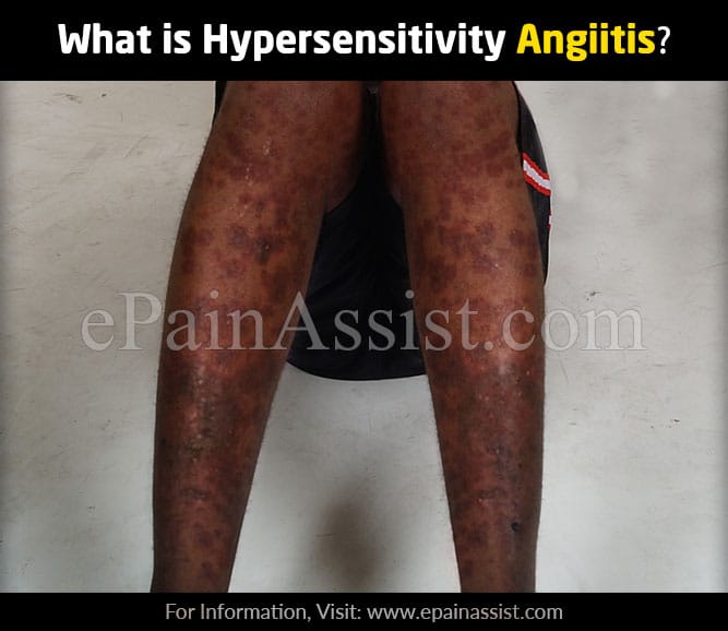 What is Hypersensitivity Angiitis &  How is it Treated?