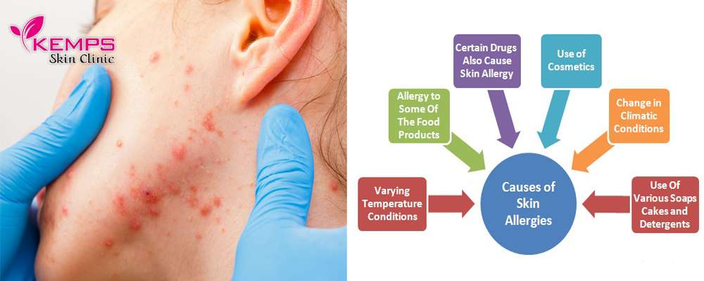 What is the root cause of skin allergies?