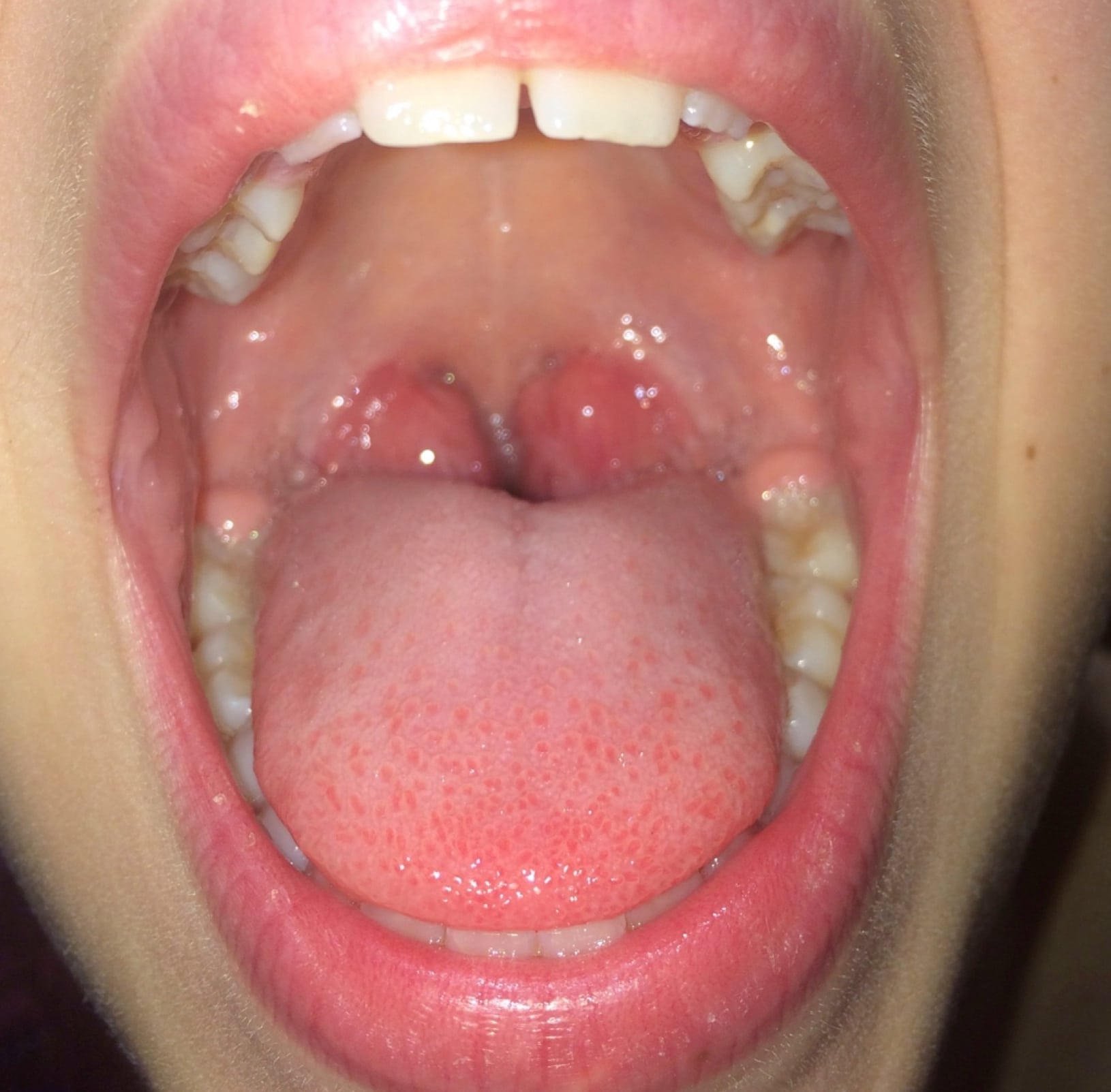 What is tonsillitis?  ent4kids
