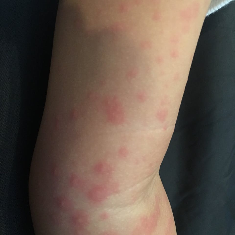 What kind of rash does this look like?