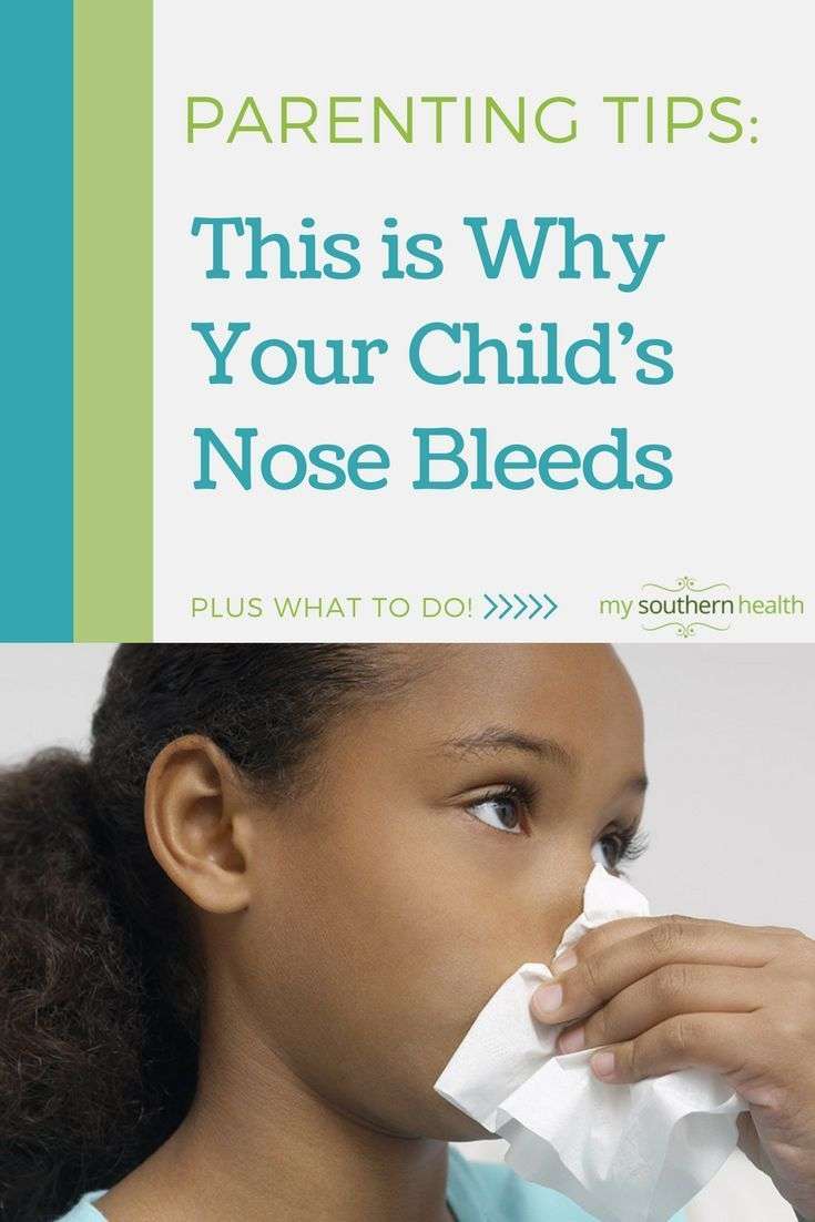 What to Do for a Nose Bleed
