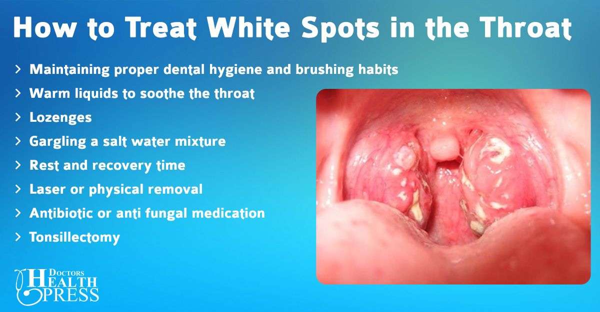 What to Know about White Spots in the Throat