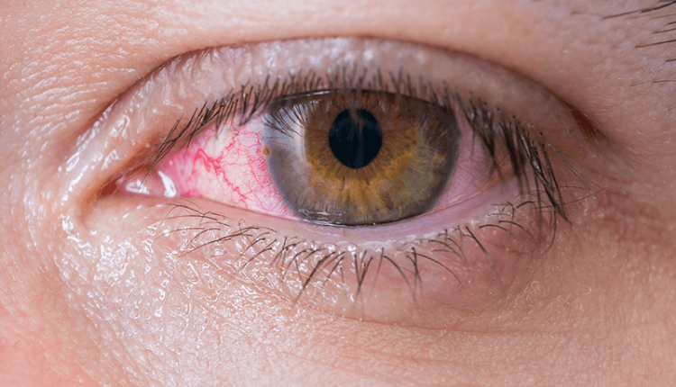 What you Should Know about Eye Allergies â Top Sites Health