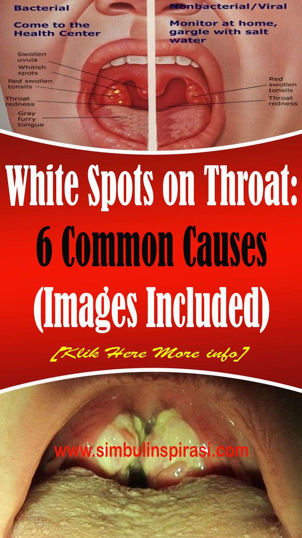 White spots on the throat are normally an indication of ...