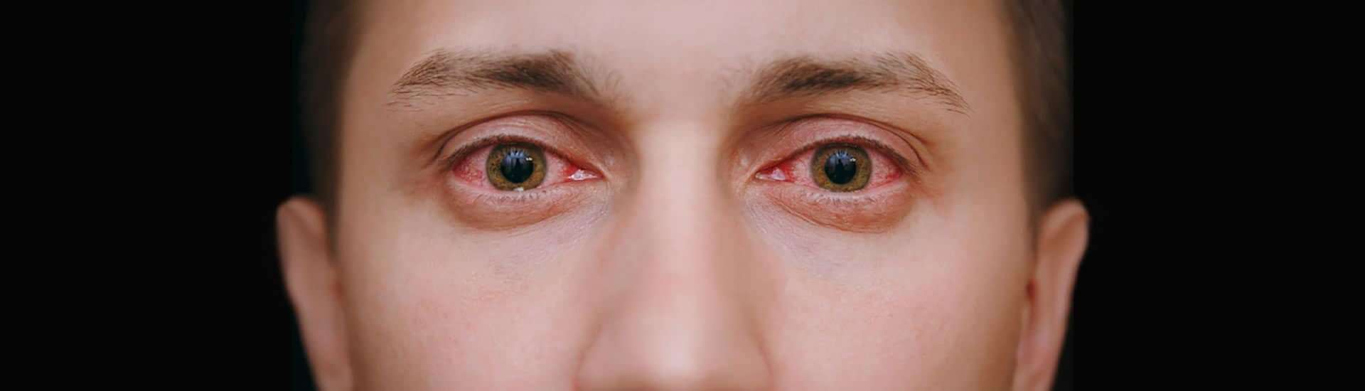 Why Allergies Make Your Eyes Red and Itchy