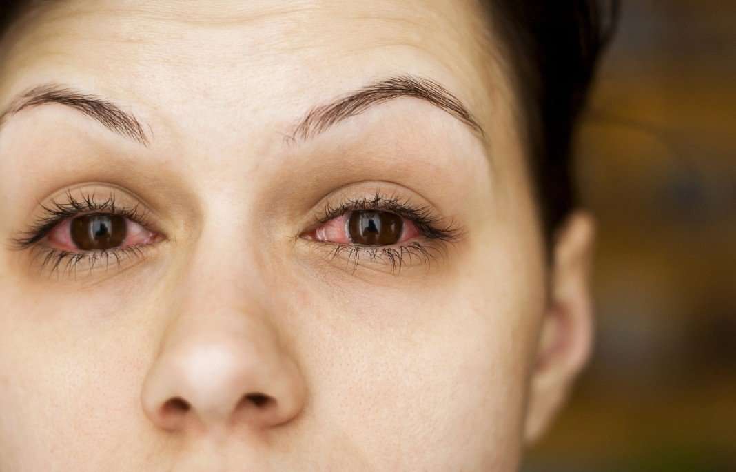 Why Is My Eye Twitching? 7 Reasons That Causes This Annoyance!