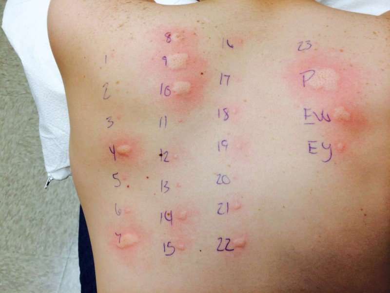 Why you should consider food allergy testing