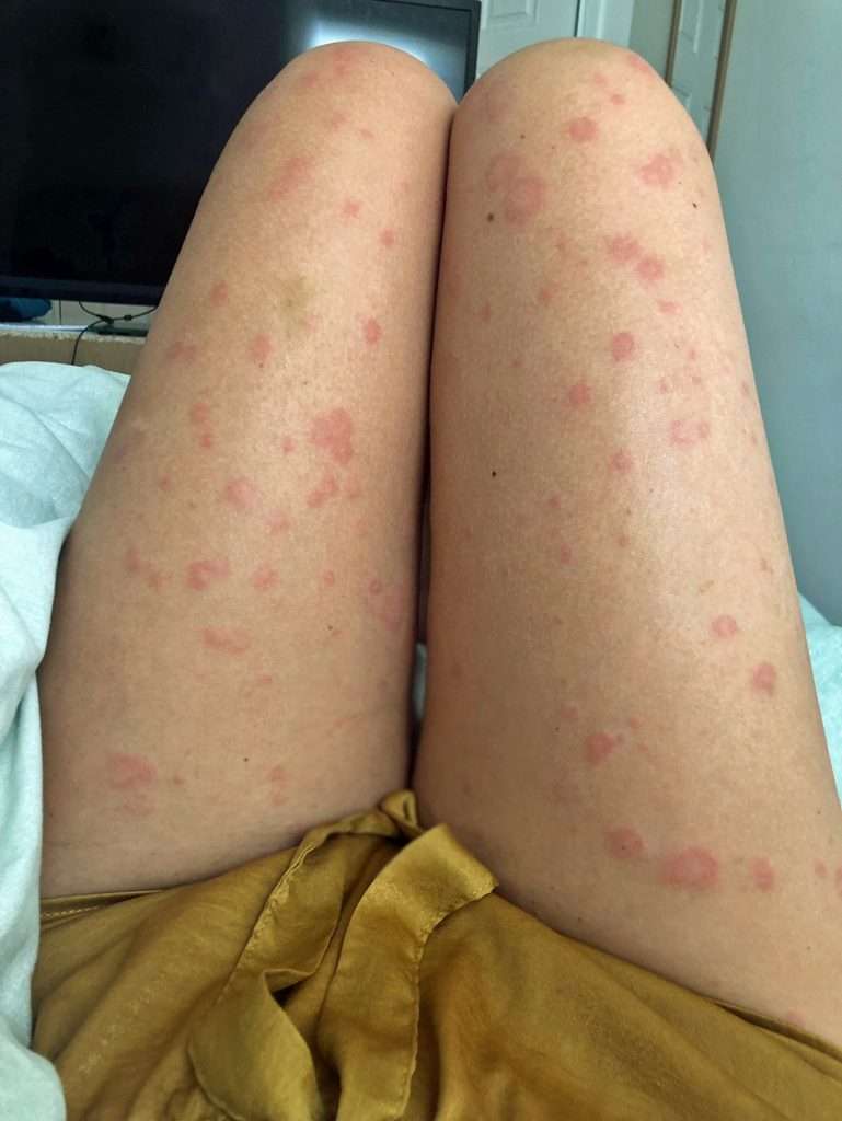 » Woman Branded contagious For Mystery Allergy That ...