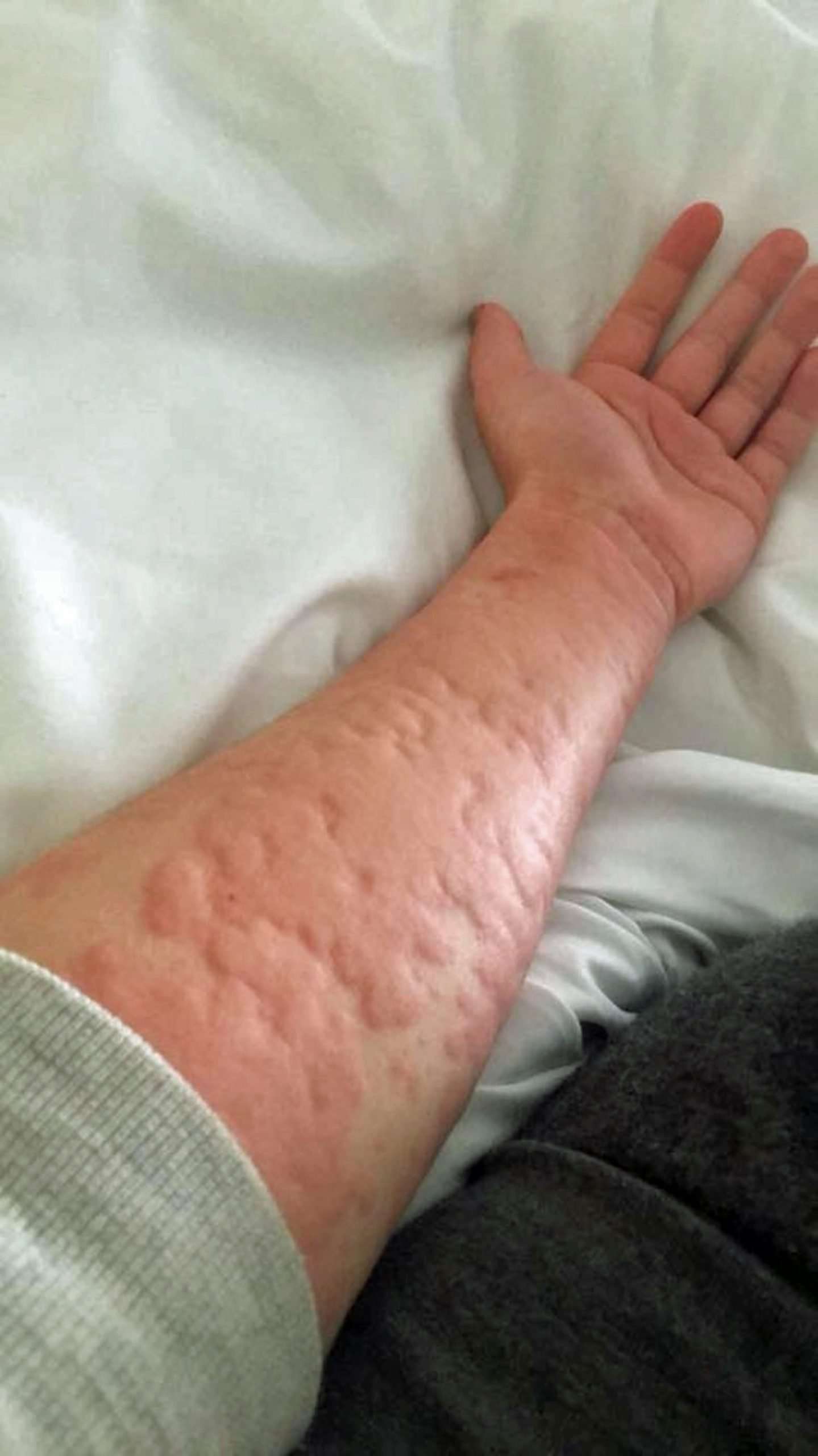 Woman with winter allergy speaks out on condition after ...