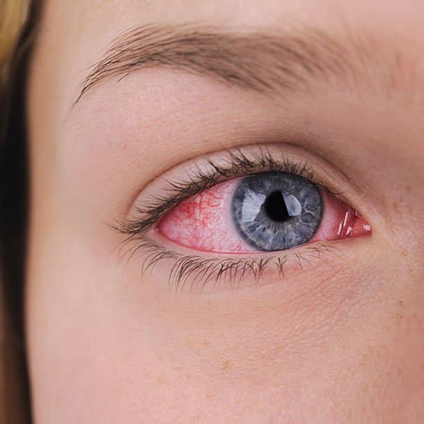 Worst Eye Disease To Get