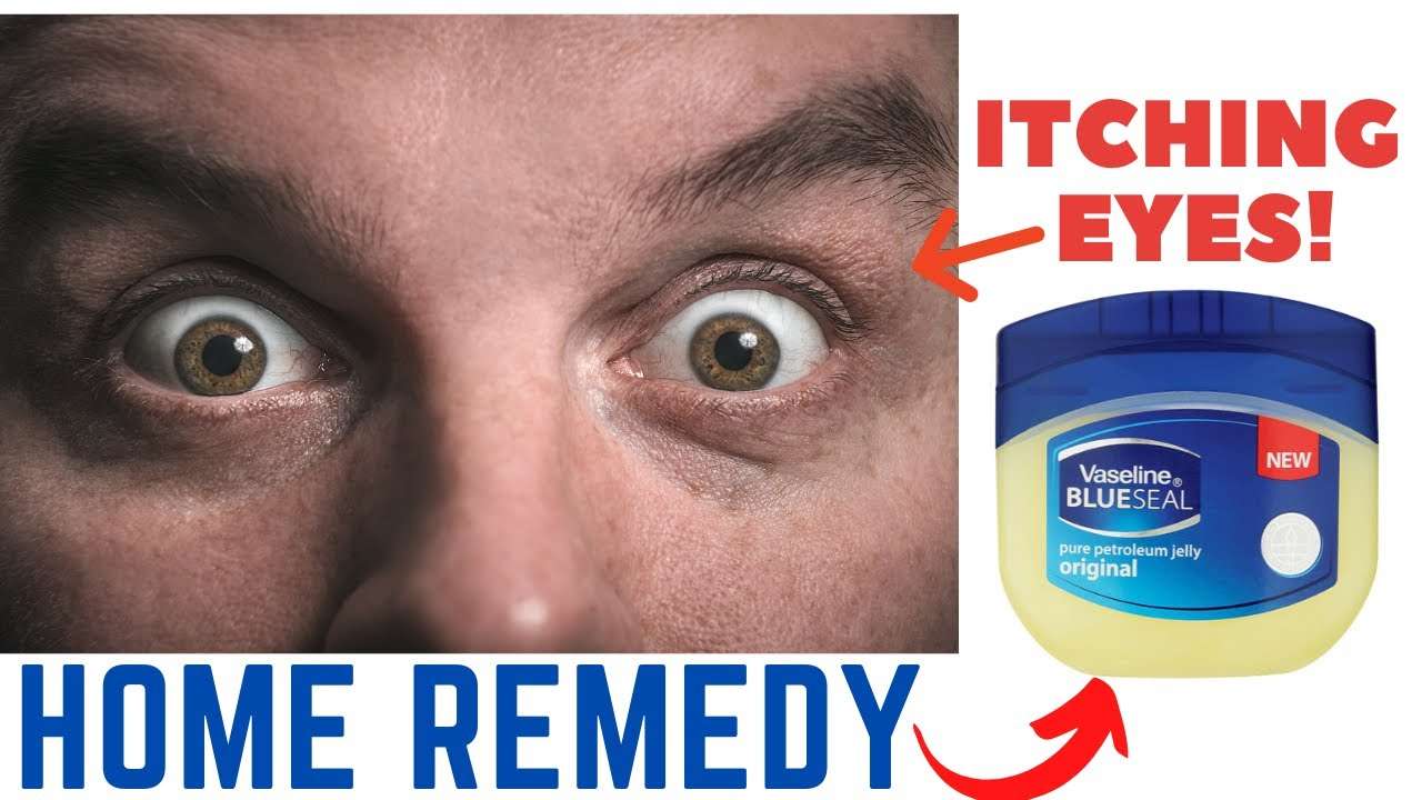 ðhow To Get Rid Of Itchy Eyes ð?¼ð Itchy Eyes Home Remedy Honest Video ...